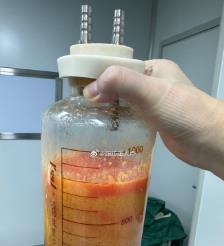 绥化水动力吸脂手术要做多久？